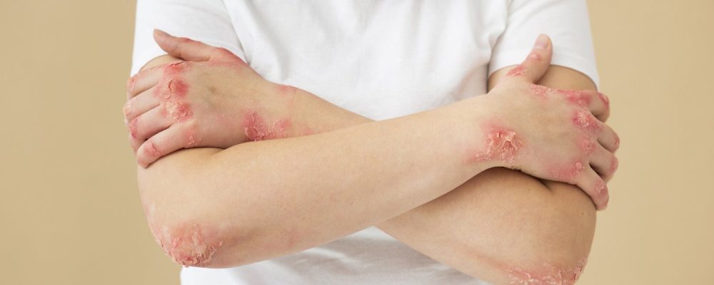 Egzama-Sedef-Alerjilerde-Beslenme